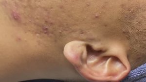 Полное избавление от прыщей