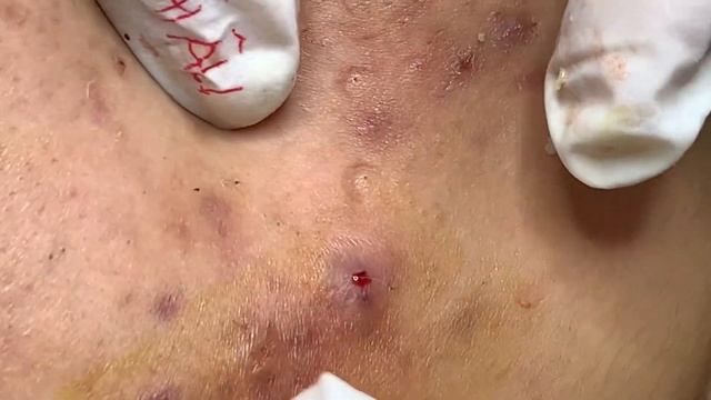 Asmr. Чистка кожи от подкожных угрей. смотреть онлайн