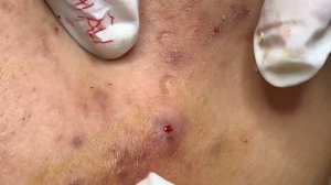 Asmr. Чистка кожи от подкожных угрей.