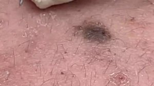 Очищение кожи от черных точек. # 058