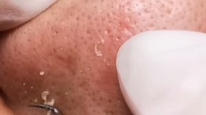 Чистка лица от угрей и акне. Выдавливание прыщей. Удаление черных точек и комедонов