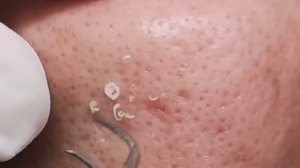 Чистка лица от угрей и акне. Выдавливание прыщей. Удаление черных точек и комедонов