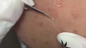 Удаление черных точек и прыщей. #105