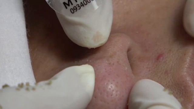 Черные точки на носу. Лечение акне #109 LinhM смотреть онлайн