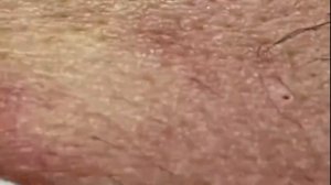 Попрощайся с черными точками навсегда! #УходЗаКожей #УдалениеЧерныхТочек