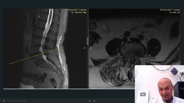 Смещение позвонков вперед и в сторону. Позвоночник стал зарастать. Разбор интересного случая.