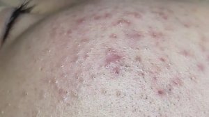 Очищение кожи от черных точек. # 058