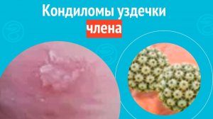 👉 Кондиломы уздечки члена. Клинический случай № 1745