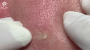 Удаление подкожных прыщей (закрытых комедонов) и черных точек #104.