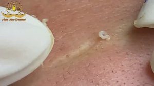 Asmr. Чистим кожу от черных точек. #005