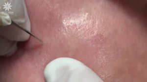 Удаление подкожных прыщей (закрытых комедонов) и черных точек #104.