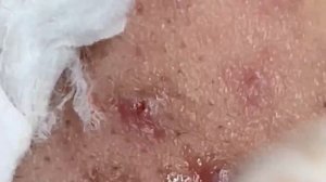 Удаление комедонов и сальных пробок. Asmr # 015