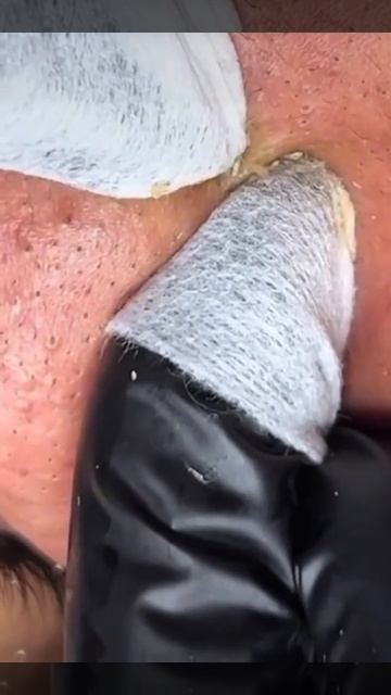 Чистка лица от угрей и акне. Выдавливание прыщей. Удаление черных точек и комедонов смотреть онлайн