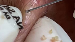 Чистка кожи лица от комедонов и угрей. Asmr #057