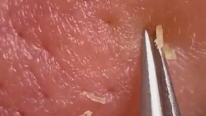 Чистка лица от угрей и акне. Выдавливание прыщей. Удаление черных точек и комедонов