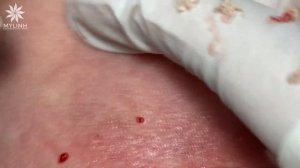 Удаление подкожных прыщей (закрытых комедонов) и черных точек #104.