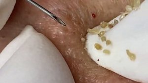 Выдавливание прыщей, угрей, черных точек и камедонов #207