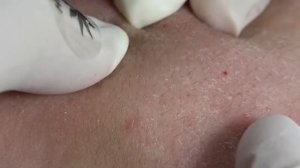 Лечение акне #110: Вокруг рта и подбородка