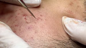 Asmr. Чистим лицо от черных точек.