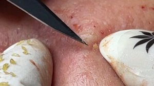 Asmr. Механическое очищение от сальных пробок. #105(Linh)P3