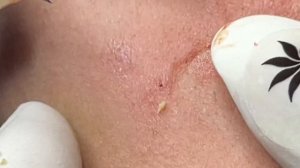 Профессиональное удаление комедонов: тонкая работа мастера. #106(Linh)