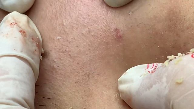 Механическая чистка от воспаленных прыщей смотреть онлайн