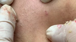 Механическая чистка от воспаленных прыщей