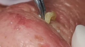 Чистка лица от угрей и акне. Выдавливание прыщей. Удаление черных точек и комедонов