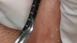 Чистка лица от угрей и акне. Выдавливание прыщей. Удаление черных точек и комедонов