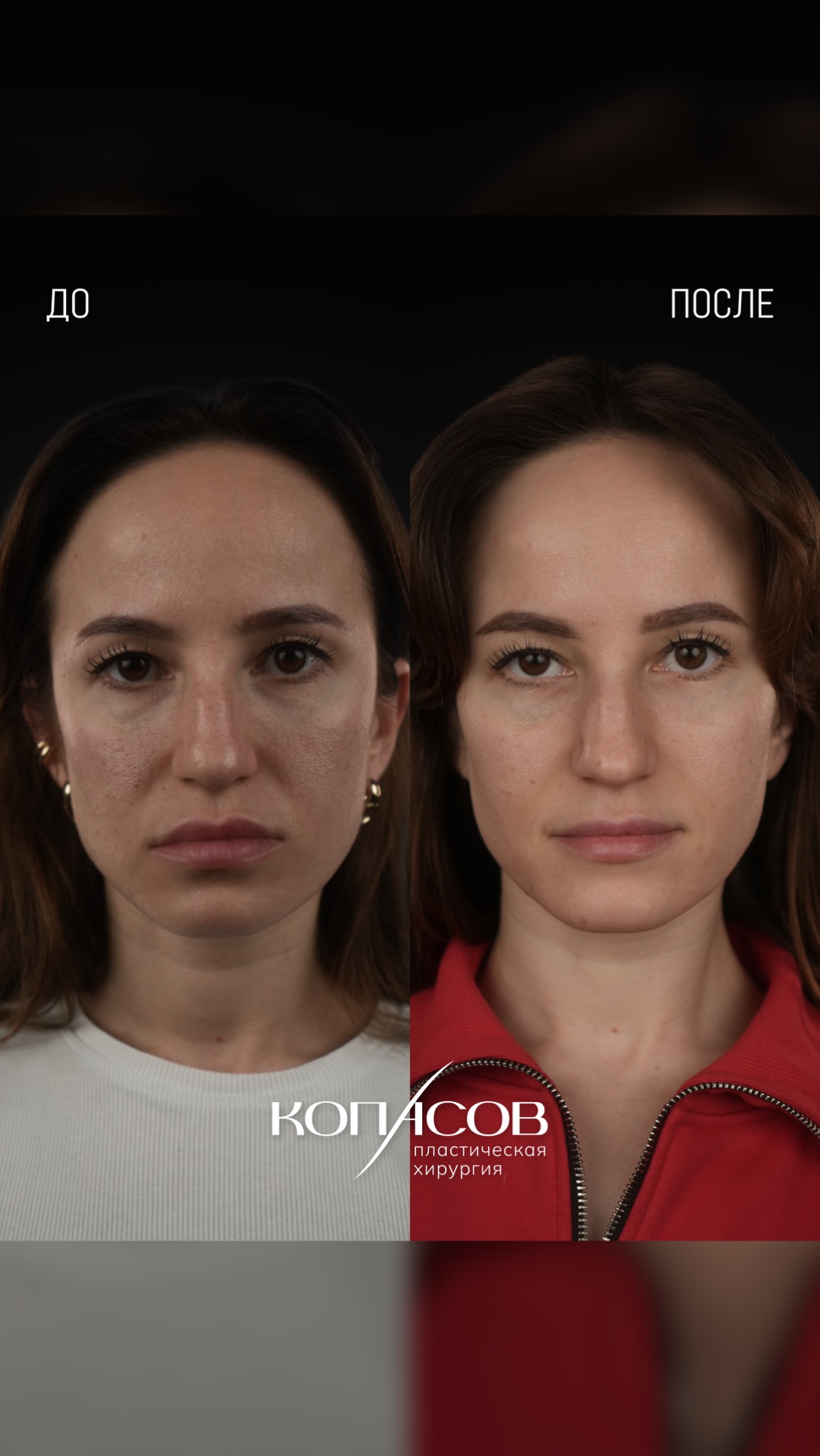 Трансконъюктивальное ремоделирование для моей невероятной пациентки🥰