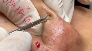 Asmr. Чистка лица от себорейных угрей.