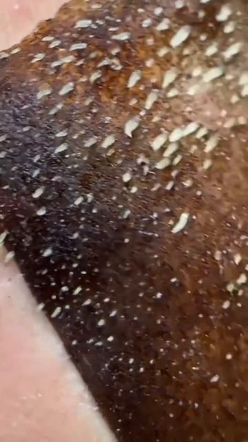 Чистка лица от угрей и акне. Выдавливание прыщей. Удаление черных точек и комедонов смотреть онлайн