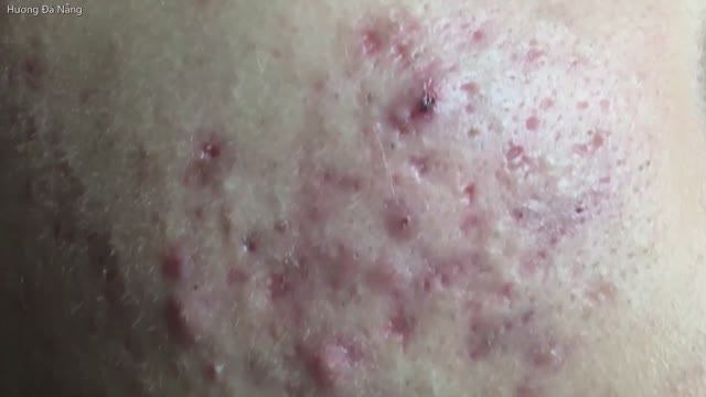 Многолетние прыщи на лице. Запущенные прыщи привели к гиперпигментации всего лица. смотреть онлайн