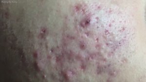 Многолетние прыщи на лице. Запущенные прыщи привели к гиперпигментации всего лица.