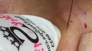 Лечение от черных точек и сальных пробок. 5563