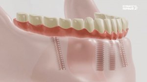 Здоровая улыбка России. Сколько служит имплант и как часто нужно менять коронку?