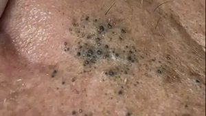 Профессиональное очищение от угрей и сальных пробок. Asmr. 118