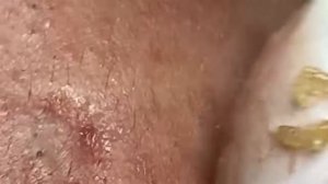 Механическая чистка от черных точек и комедонов. Asmr #7890