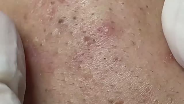 Удаление крупных прыщей и кист. 224 смотреть онлайн