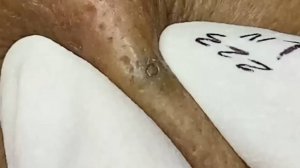 Удовлетворяющее удаление черных и белых точек, расслабляющее выдавливание прыщей