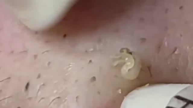 Уход за кожей: удаление черных точек смотреть онлайн