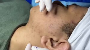 Asmr. Лечим прыщи, комедоны и сальные пробки. 8