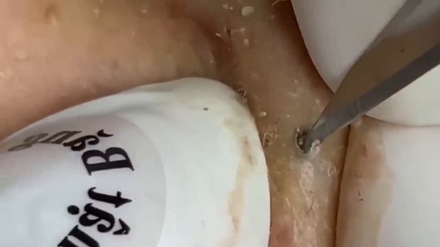 Лечение жирной кожи: чистка пор 113 смотреть онлайн