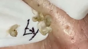 Удовлетворяющее удаление черных и белых точек, расслабляющее выдавливание прыщей