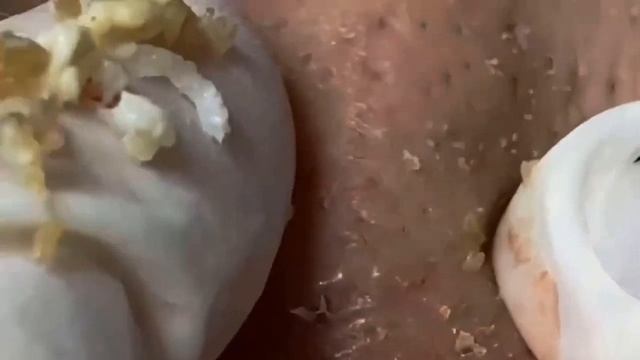 Лучшие моменты чистки лица #111 смотреть онлайн