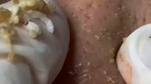 Лучшие моменты чистки лица #111