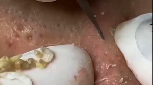 Профессиональное очищение от угрей и сальных пробок. Asmr. 118