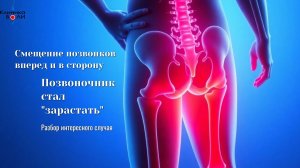 Смещение позвонков вперед и в сторону. Позвоночник стал «зарастать». Разбор интересного случая.