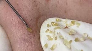 Выдавливание прыщей, угрей, черных точек и камедонов #210