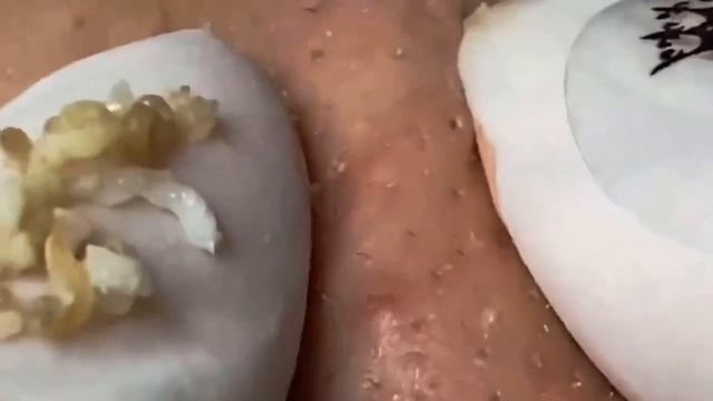 Терапия прыщей: смотреть и расслабляться 112 смотреть онлайн